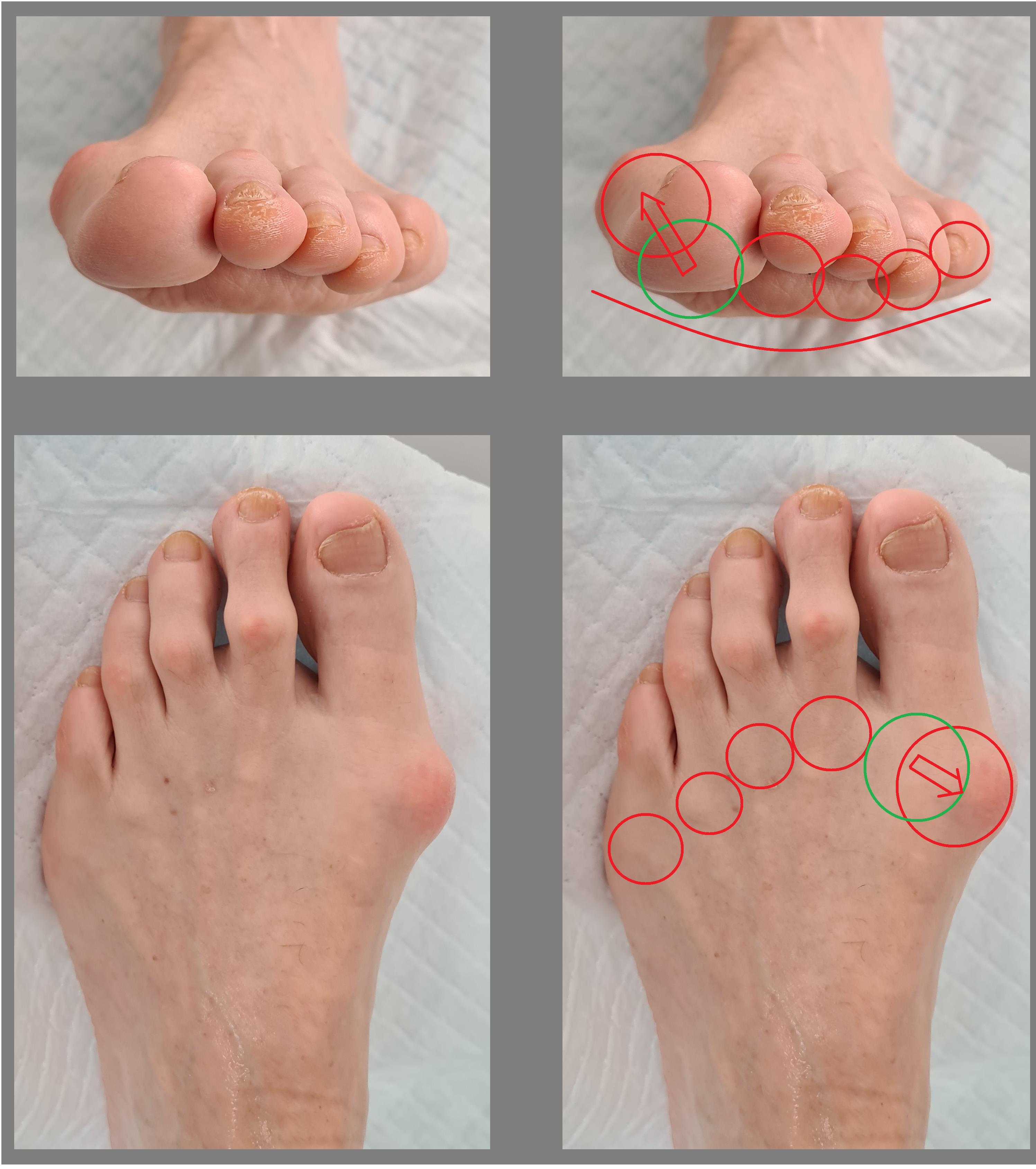 Косточка на большом пальце ноги: незначительный дефект или серьезная проблема - Клиника Лоритом